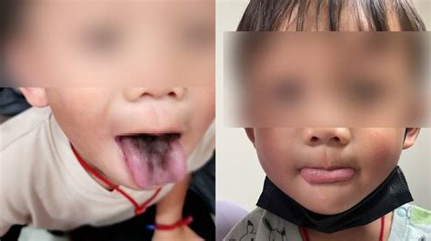 4歲童出現罕見「黑毛舌」！醫師曝與抗生素使用有關 「這些」習慣也有風險 Beanfun