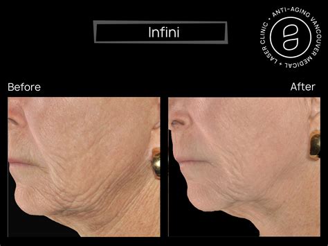 Cosmetic Treatments Combining Exosome Therapy With Infini Microneedling