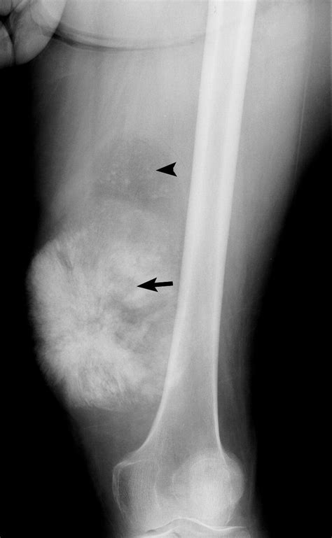 Dedifferentiated Liposarcoma Of Soft Tissue With High Grade