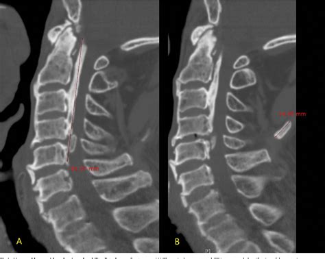 Ossification Posterior Longitudinal Ligament