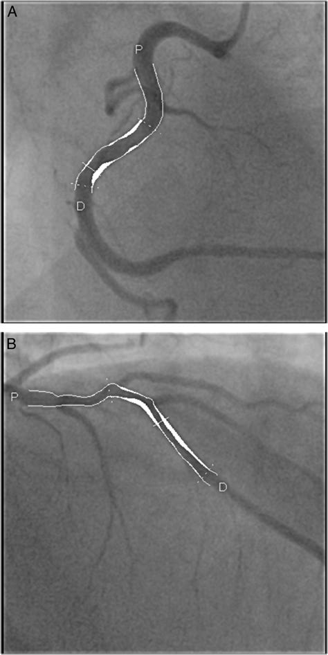 Lower Coronary Plaque Burden In Patients With HIV Presenting With Acute