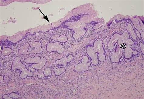 Mucinous Neoplasms Of The Ovary Radiologic Pathologic Correlation