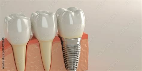 3D Render Of A Dental Implant In Jaw Background With Copy Space