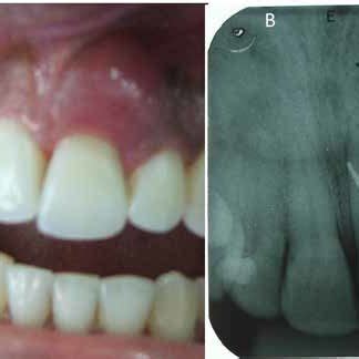 A. Drainage of suppurative periodontal abscess via periodontal pocket... | Download Scientific ...