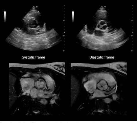 Figure 1 From Echocardiogra A Case Of Quadricuspid Aortic Valve