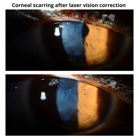 Corneal Scarring After Laser Vision Correction Dr Anthony Maloof