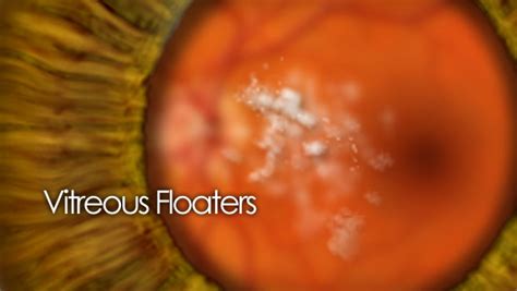 What Are Floaters In The Eye A Detailed Patient Guide To Eye Floaters