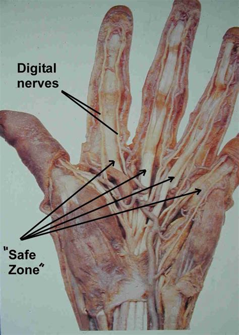 Trigger Finger Injections