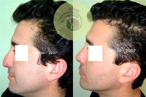 Rhinoplasty Nasal Tip Ptosis 033 Π Κόλλιας