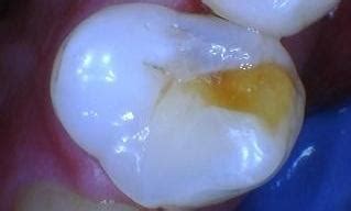 Bridge Dental Care's Smile Gallery | Cavity on top middle tooth(premolar)