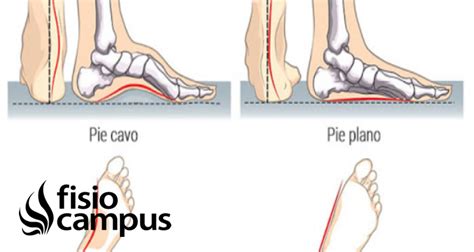 Pie cavo Qué es causas síntomas a quién afecta y tratamiento