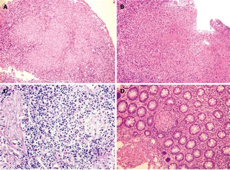 Histological Features A Confluent Granulomas In Inflammatory Download Scientific Diagram