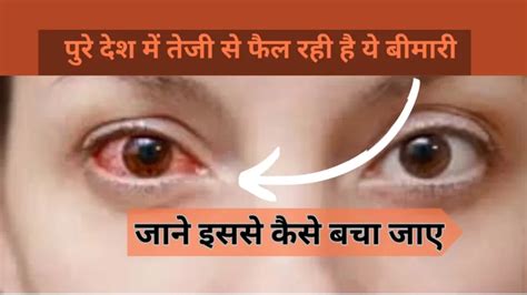 Eye Flu Conjunctivitis पुरे देश में तेजी से फैल रही है ये बीमारी जाने इससे कैसे बचा जाए