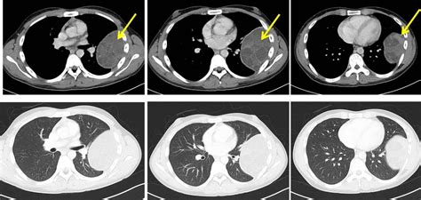 Pleural based mass – Radiology Cases