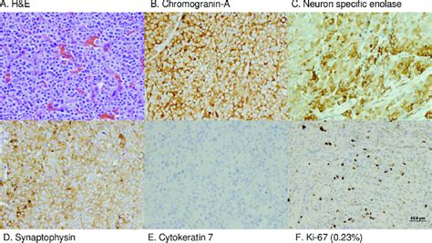 Neuroendocrine neoplasm H&E histology and immunohistochemical staining ...