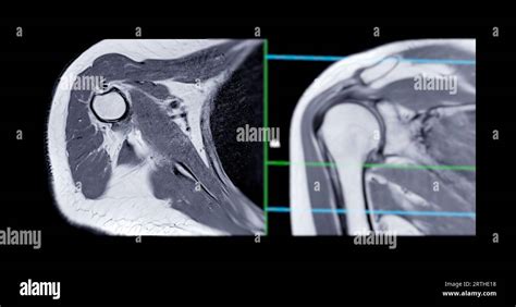 Magnetresonanztomographie Oder Mrt Des Schultergelenks Bei