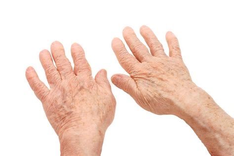 Rheumatoid Arthritis Hands Stock Image Image Of Fingers 41407123