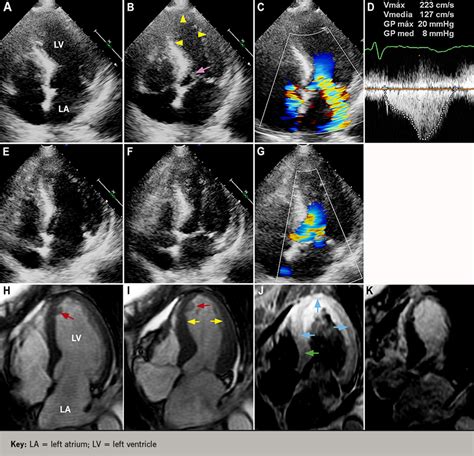 Takotsubo Syndrome The Broken Heart Syndrome