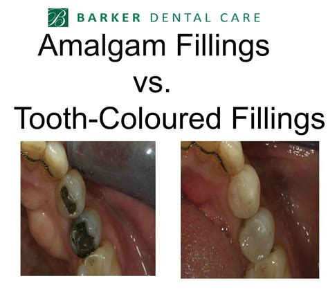 Amalgam Fillings Guidelines At Paula Calvo Blog