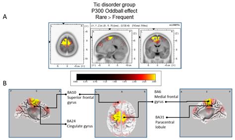 Brain Sciences Free Full Text P Source Localization Contrasts In