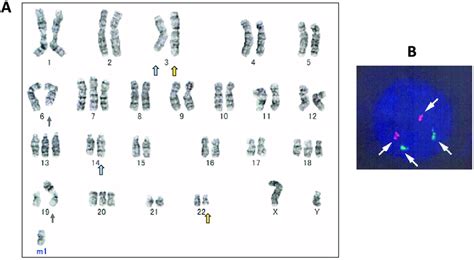 Cytogenetic Findings Of Lymphoma Cells A G Banded Karyotype Arrows Download Scientific