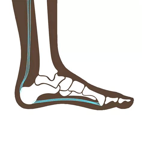 Calcaneal Spur The Complete Guide Causes And Treatments