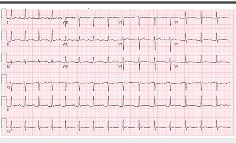 PDF A Rare Case Of High Grade Atrioventricular Block In