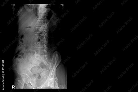 X Ray Image Of Lumbar Spine Right Side Lumbar Degenerative Spinal