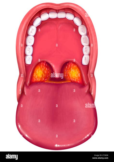 ACUTE TONSILLITIS Stock Photo - Alamy