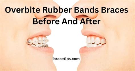 Overbite Rubber Bands Braces Before And After