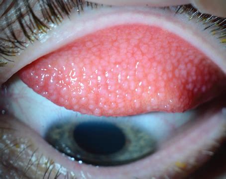 Giant Papillary Conjunctivitis