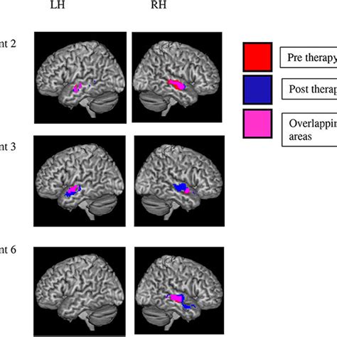 Lesion Overlap Map For Patients Who Successfully Underwent Fmri