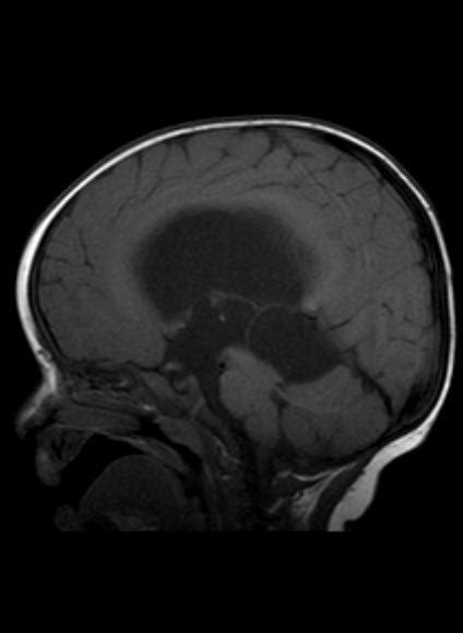 Quadrigeminal Cistern Arachnoid Cyst Causing Hydrocephalus Image