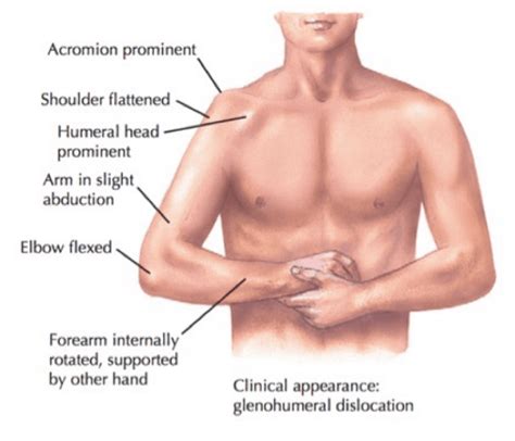 The Complete Guide To Shoulder Instability Kinetic Labs