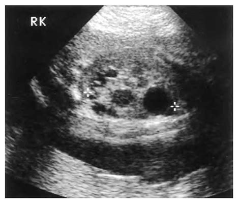 Approach And Management Of Pediatric Hydronephrosis Epomedicine