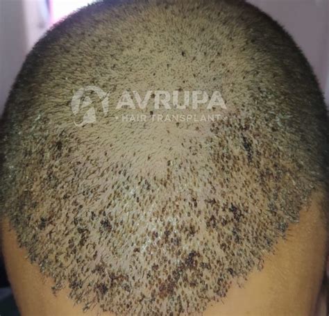 Scabs After Hair Transplant When And How To Get Rid Of Them