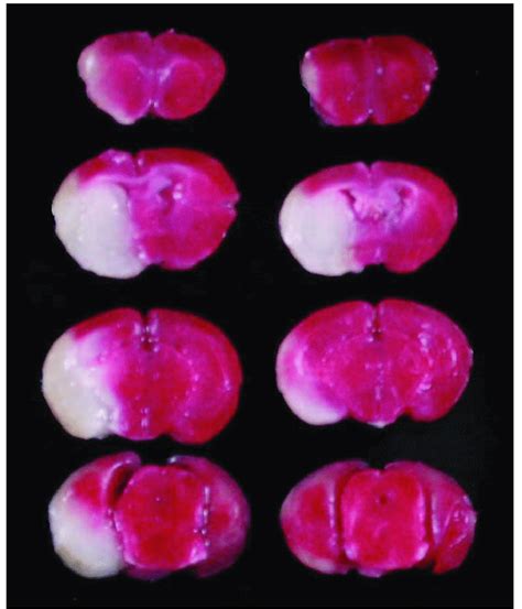 Triphenyltetrazolium Chloride Ttc Staining Of Coronal Brain