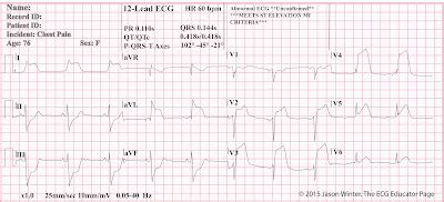 ECG Educator Blog 07 31 16