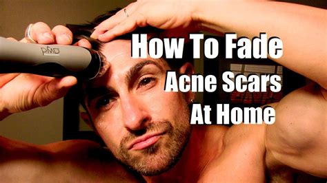 How To Fade Acne Scars Reduce Breakouts Even Skin Tone At Home Youtube