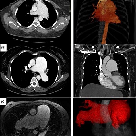 Preoperative Computed Tomographic Angiography And Magnetic Resonance