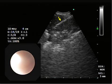 Image With A Convex Linear Endobronchial Ultrasound Probe Notes The