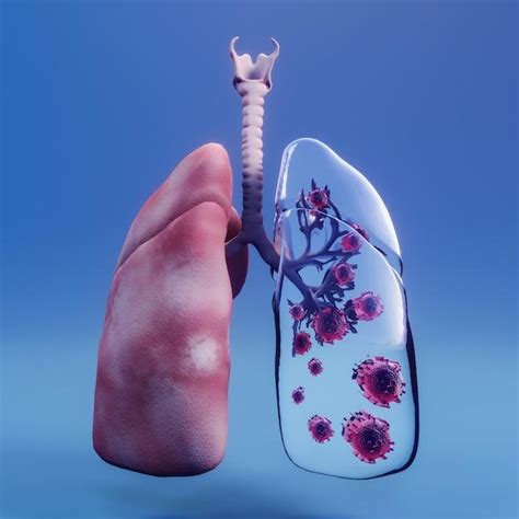 Lung Infection Symptoms Causes And Treatments Motivation For Health