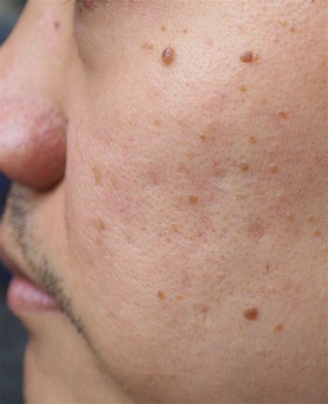 Moles Face Restoration Facial Aesthetics London Harley Street