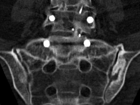 Sacral Fractures After Lumbosacral Fusion A Characteristic Fracture Pattern Ajr