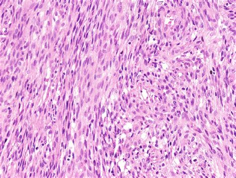 B Ntrk Positive Tumor Resembling Peripheral Nerve Sheath Tumour A