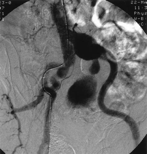 Common Iliac Artery Aneurysm