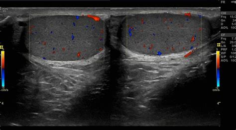 Ecografía Testicular En Concepción Ecotomografía