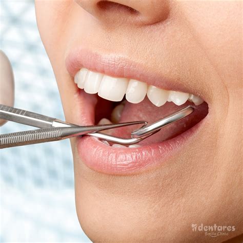 How To Get Your Teeth Done In Turkey Dentares Dental Centre Turkey