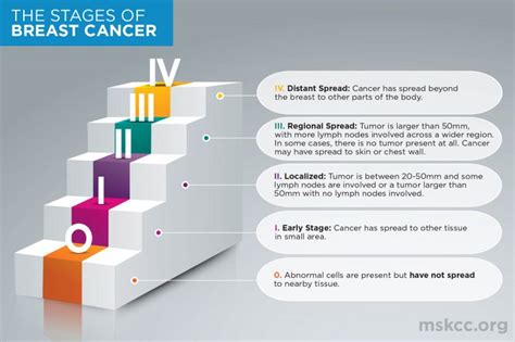 Breast Cancer Stages And Memorial Sloan Kettering Cancer