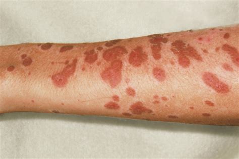 Stevensjohnson Syndrome And Toxic Epidermal Necrolysis The